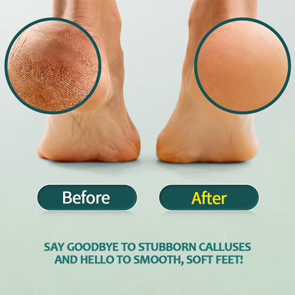 Nailpop Professional Callus Remover for Feet Extra Strength Gel & Rasp Foot File Kit Dead Skin Remover Cracked Heels Dry Skin