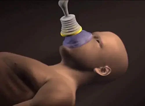 Professional Anti Choking  Emergency Device for adults/children
