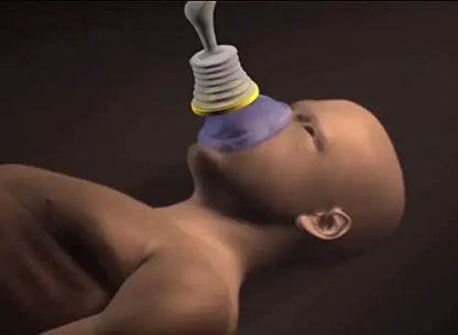 Professional Anti Choking  Emergency Device for adults/children